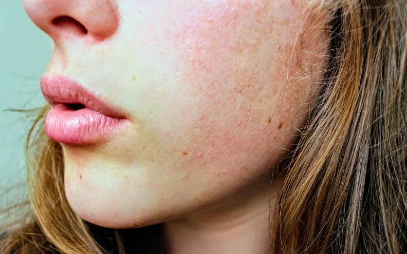 blemish control cleanser​